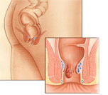 homorrhoids
