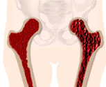 osteoporosis