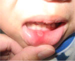 ulcers